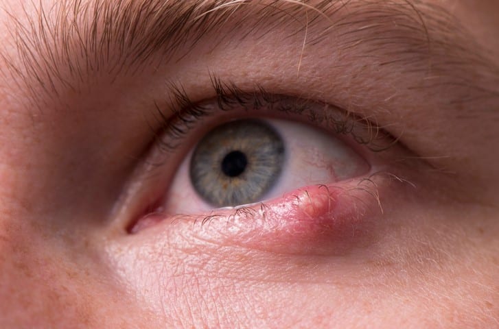 درد و التهاب پلک به علت تبخال چشمی